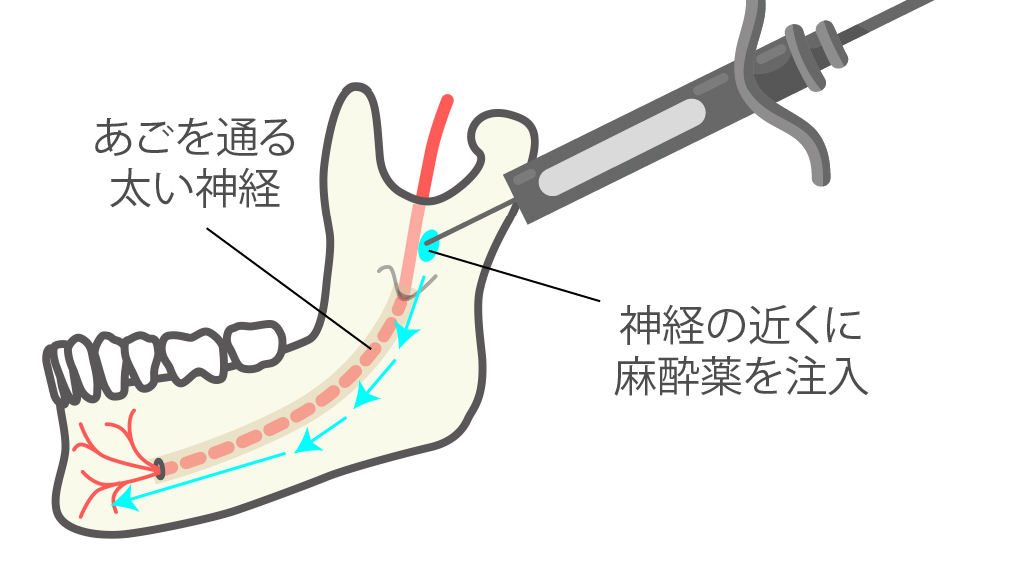 伝達麻酔