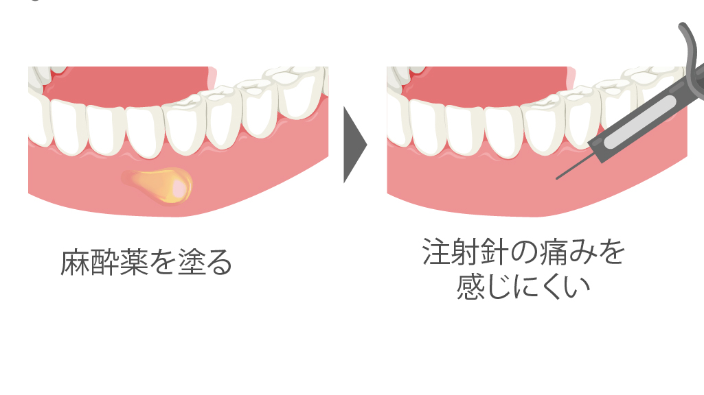 表面麻酔